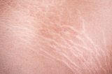 The Frustrating Reality of Stretch Marks