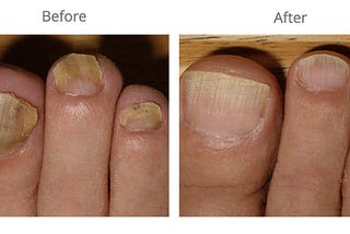 Toenail Fungus as a Potential Indicator of Underlying Medical Conditions: A Scientific Study