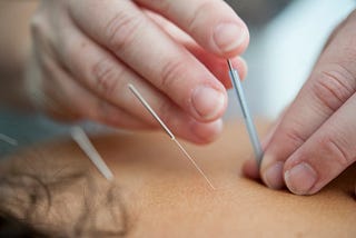 Namaste: Acupuncture Worked for Me