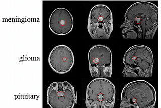 Brain tumor MRI image classification