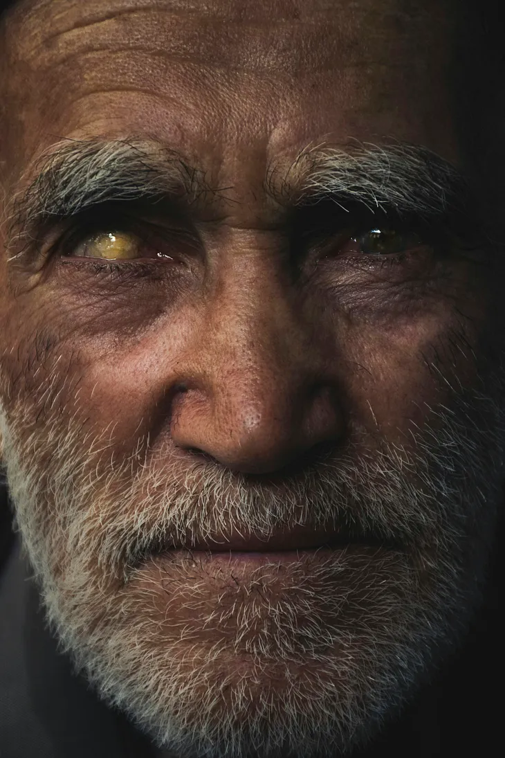 A close-up shot of a Caucasian man with severe cataracts and/or blindness in his right eye. He has a blank expression and has grey eyebrows and facial hair.