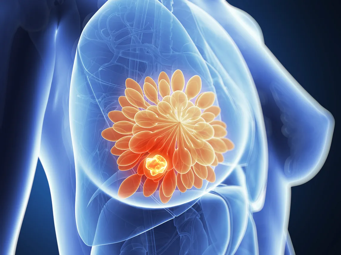 An illustration of a transparent woman’s torso. We see a tumor in her right breast.