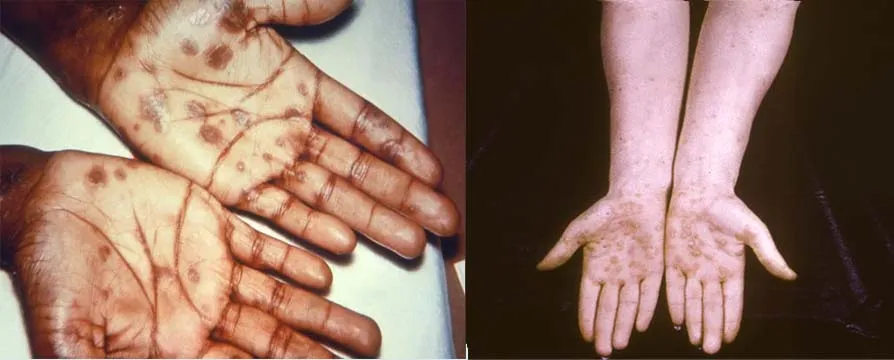 Images of syphilis rash on the hands and arms of two different patients